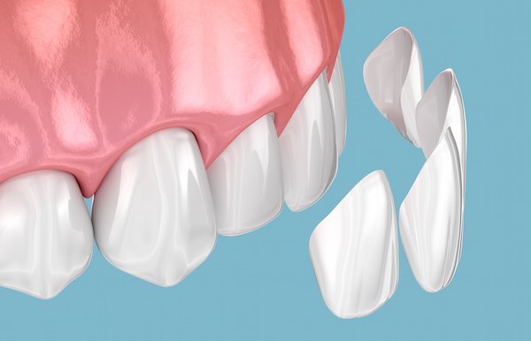 Porcelain Veneers